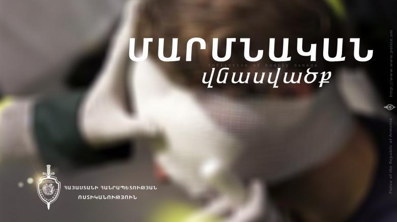 Վիճաբանության ժամանակ կրակել էր ծանոթի աչքին Վիճաբանության ժամանակ կրակել էր ծանոթի աչքին